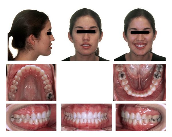 palate expander adult before after 2
