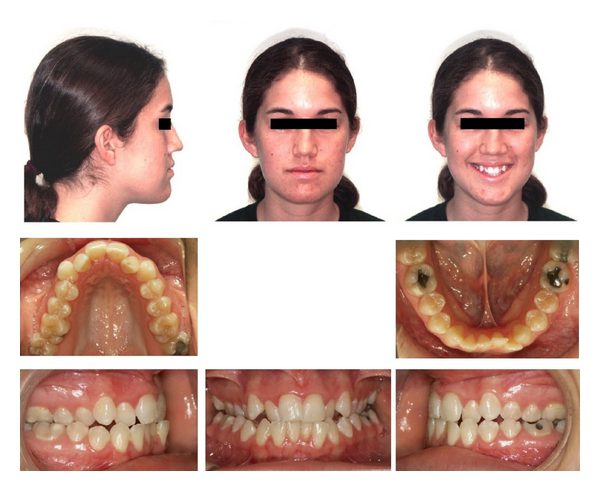 palate expander adult before after