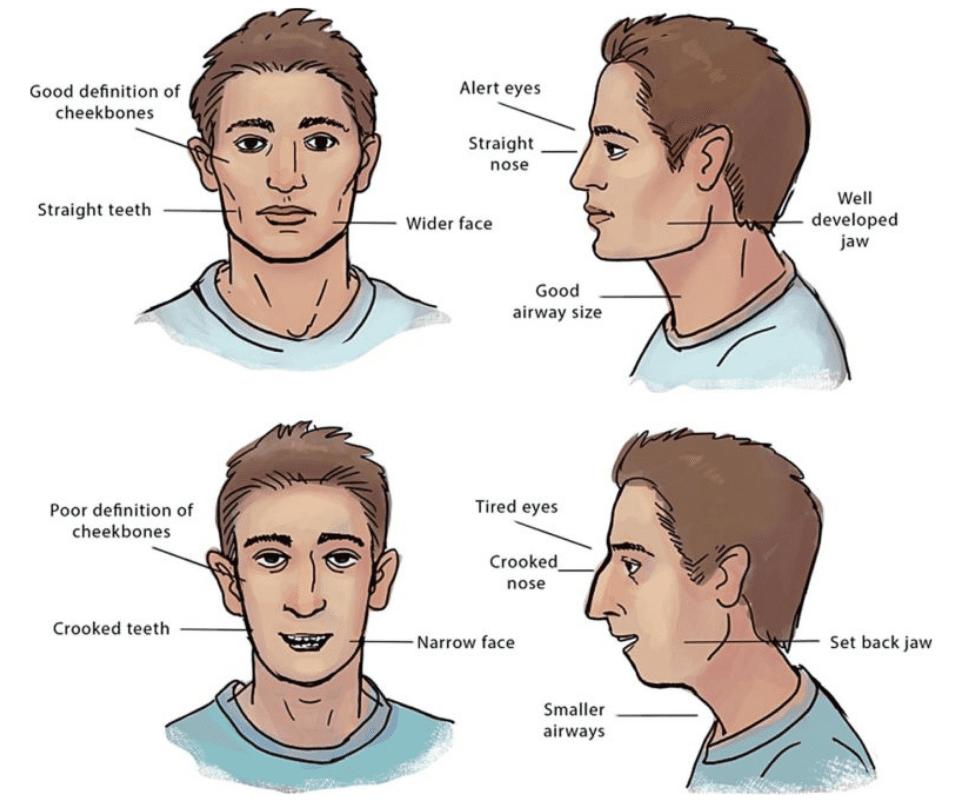 recessed maxilla vs prominent maxilla