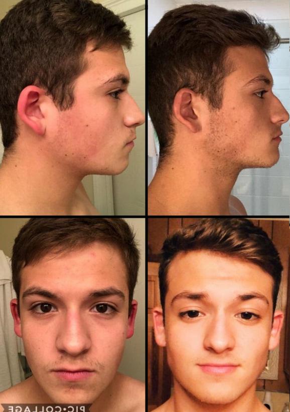 My 1 year mewing transformation from the 15 me recently turning 16M : r/ Mewing