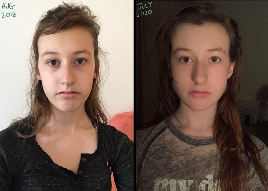3 years and 9 months, 18-21 years old : r/Mewing
