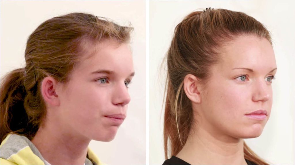 Face Pulling - Improve your facial appearance with mewing and headgear